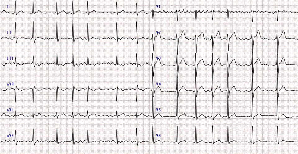 心房細動と生活習慣との関係 心電図