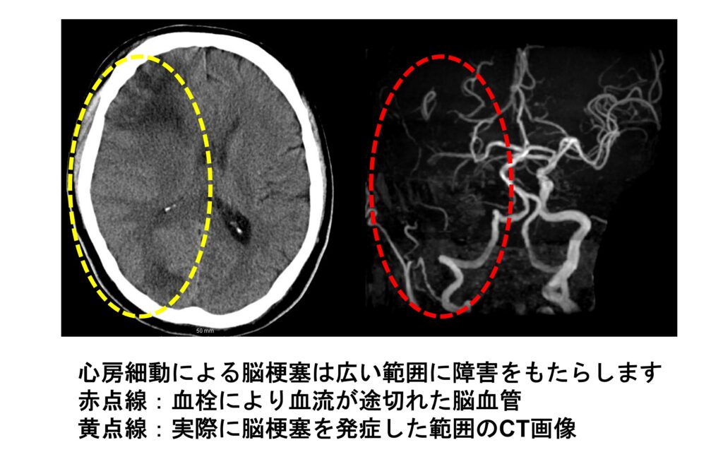 心房細動における抗凝固療法(血液サラサラ)の意義