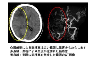 心房細動における抗凝固療法（血液サラサラ）の意義